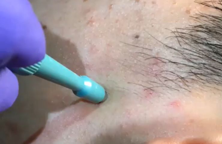 mai visto nulla simile dottoressa Pimple Popper sconvolta